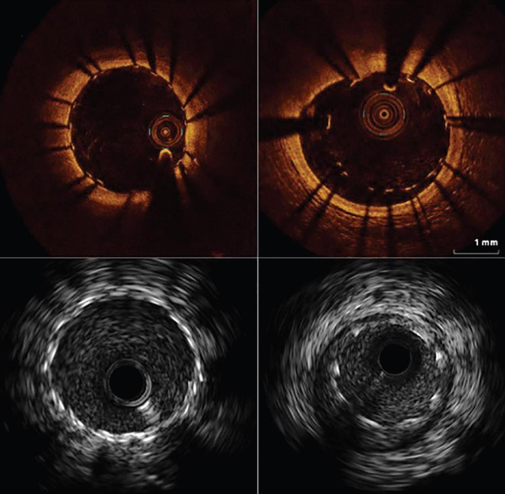 OCT and IVUS Showing a