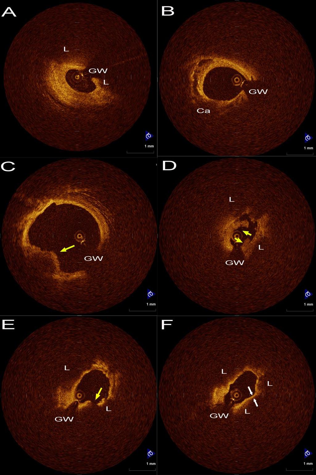 Evaluation of culprit lesion in ACS revealed multiple