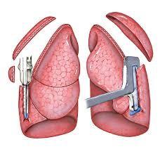 ΠΑΡΕΜΒΑΤΙΚΕΣ ΘΕΡΑΠΕΙΕΣ Lung Volume Reduction Surgery Αφαίρεση τμημάτων των