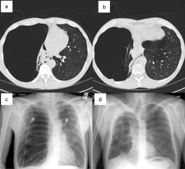 ΠΑΡΕΜΒΑΤΙΚΕΣ ΘΕΡΑΠΕΙΕΣ Bullectomy Εμφυσηματικές κύστεις με διάμετρο >1cm, ενώ γιγάντιες μπούλες μπορεί να καταλαμβάνουν από 1/3 ως και >1/2 του ημιθωρακίου