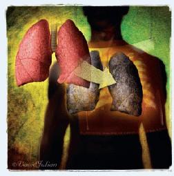 ΠΑΡΕΜΒΑΤΙΚΕΣ ΘΕΡΑΠΕΙΕΣ Μεταμόσχευση Η ΧΑΠ είναι παγκοσμίως η συχνότερη ένδειξη μεταμόσχευσης πνευμόνων (The Registry of the International Society for Heart