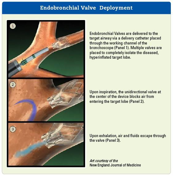 ΠΑΡΕΜΒΑΤΙΚΕΣ ΘΕΡΑΠΕΙΕΣ Ενδοβρογχικές βαλβίδες Βαλβίδες μονής κατεύθυνσης, επιτρέπουν την έξοδο αέρα από την πάσχουσα περιοχή αλλά όχι την είσοδο