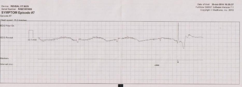 Four hours after implantation the patient suffered sudden loss of consciousness while