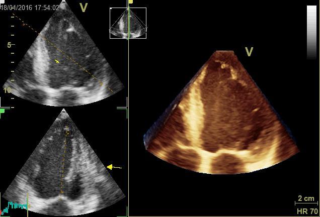 3D analiza polnega volumna ne temelji na geometričnih predpostavkah bolj primerljiva z MRI v primerjavi z 2D!