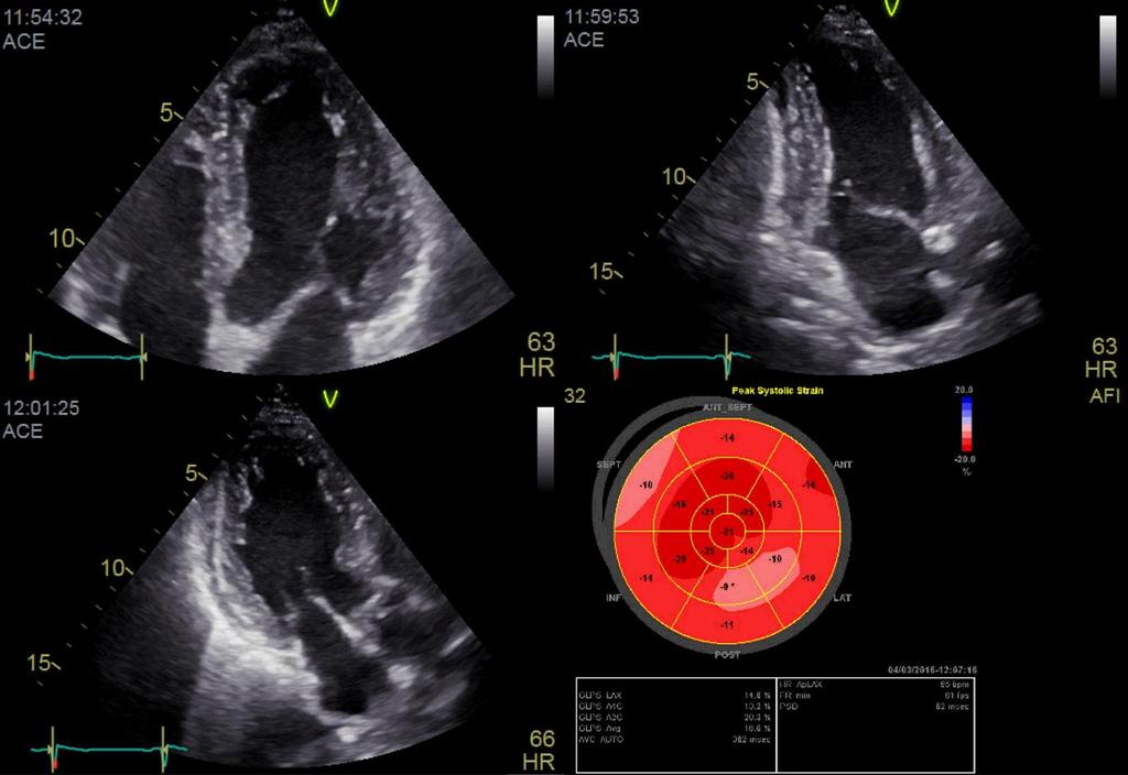 Deformacija miokarda - Speckle tracking ehokardiografija Strain (%): relativna sprememba dolžine miokarda v času Globalni longitudinalni 2D strain GLPS (%) (global longitudinal peak systolic strain)