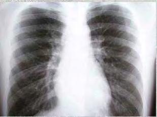 Η παρατεταμένη έκθεση σε ατμοσφαιρικούς ρύπους έχει αποδειχτεί ότι αυξάνει την εμφάνιση πνευμονικών νοσημάτων (π.χ. καρκίνος πνεύμονα) (εικόνα 5), και θανάτων από αυτά.