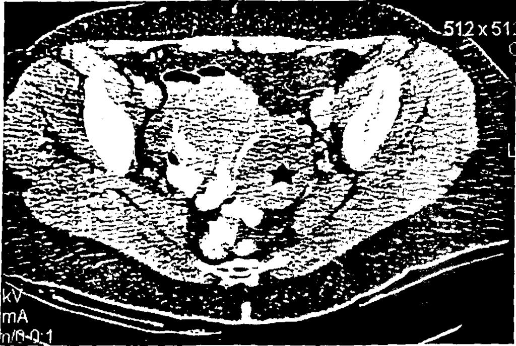 Η ύπαρξη αλλοιώσεων με περιοχές χαμηλού σήματος στις Τ2 εικόνες θεωρήθηκε συμβατή με καλοήθεις εξεργασίες, οι οποίες είτε περιέχουν λείες μυϊκές ίνες - εδώ η διαφορική διάγνωση περιλαμβάνει καλοήθεις