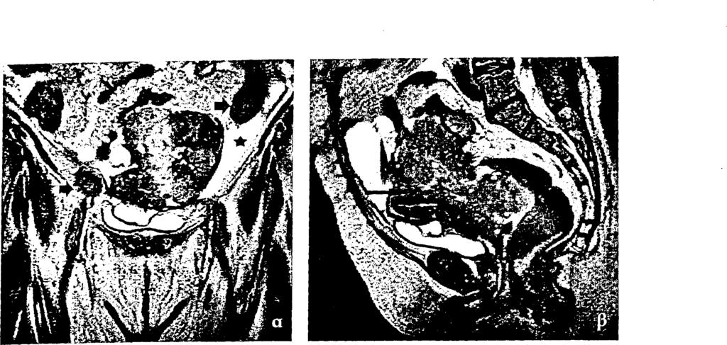 Μετωπιαία (α) και οβελιαία (β) Τ2 εικόνα, SPIR μετά σκιαγραφικό Τ Ι εικόνα σε οβελιαίο επίπεδο (γ).