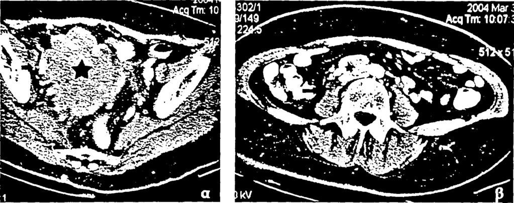 Απεικονιστικά στον έλεγχο με μαγνητική τομογραφία και στις Τ2 εικόνες δυνατόν να αναδεικνύεται το στρώμα σαν περιοχή χαμηλού σήματος, οι δε οζώδεις προσεκβολές με υψηλό σήμα [19, 20]. Εικόνα 5.