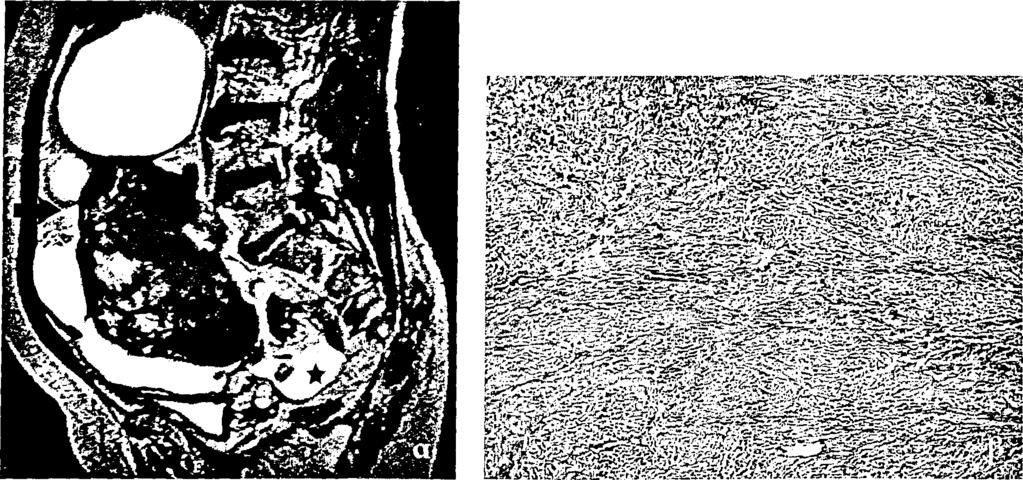 Στην μαγνητική τομογραφία οι όγκοι αυτοί, όταν είναι μικρού μεγέθους, δίνουν χαμηλό σήμα στις Τ Ι εικόνες και χαρακτηριστικά έντονα χαμηλό σήμα στις Τ2 εικόνες, αποτέλεσμα της μεγάλης περιεκτικότητας