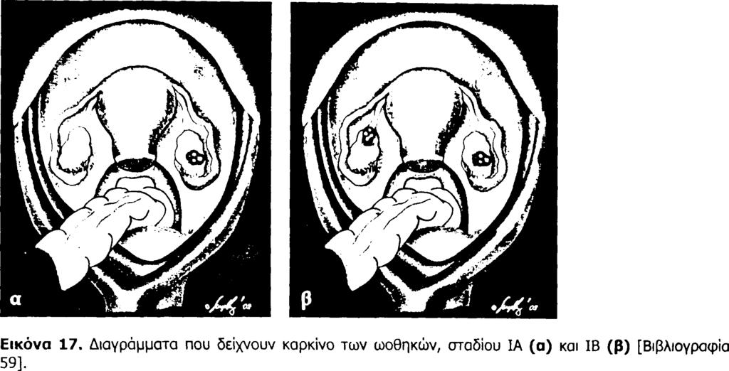 ωαγωγούς (εικ. 18α) και το στάδιο ΙΙΒ με επέκταση της νόσου στο ορθό ή την ουροδόχο κύστη (εικ. 18β).