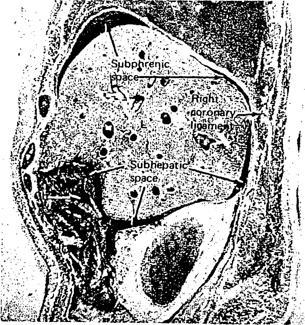 προς τον δεξιό νεφρό, προβάλλει προς τα επάνω και προς τα πίσω, υπό την μορφή του ηπατονεφρικού χώρου.