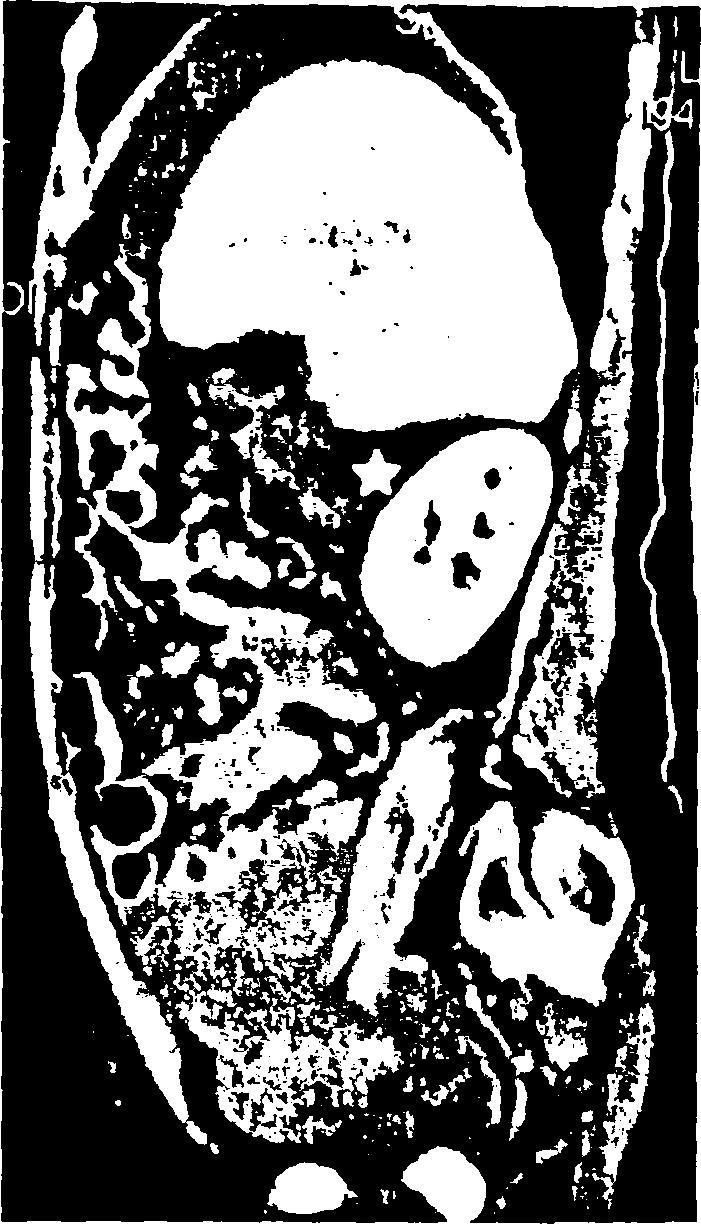 Εικόνα 37. Ίδιος ασθενής με εικόνα 34. Οβελιαία ανασύνθεση, χώρος του Morison (αστερίσκος).