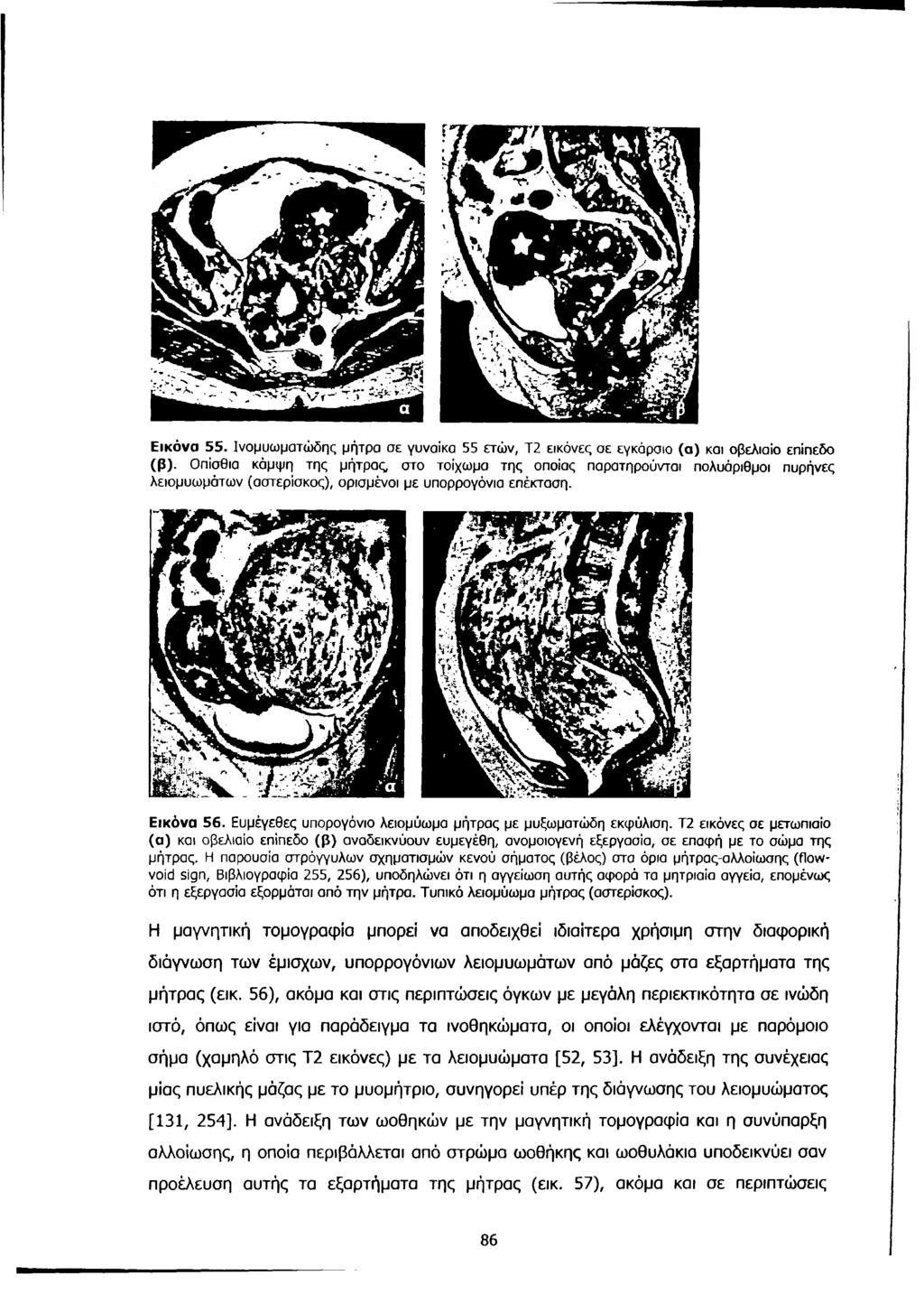 Εικόνα 55. Ινομυωματώδης μήτρα σε γυναίκα 55 ετών, Τ2 εικόνες σε εγκάρσιο (α) και οβελιαίο επίπεδο (β).