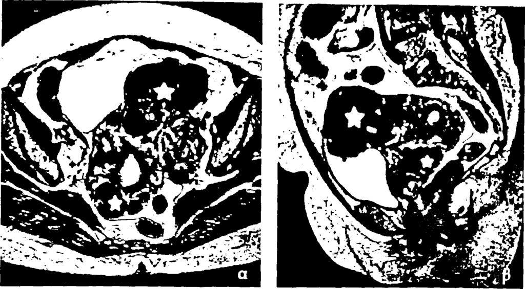 Ευμέγεθες υπορογόνιο λειομύωμα μήτρας με μυξωματώδη εκφύλιση. Τ2 εικόνες σε μετωπιαίο (α) και οβελιαίο επίπεδο (β) αναδεικνύουν ευμεγέθη, ανομοιογενή εξεργασία, σε επαφή με το σώμα της μήτρας.