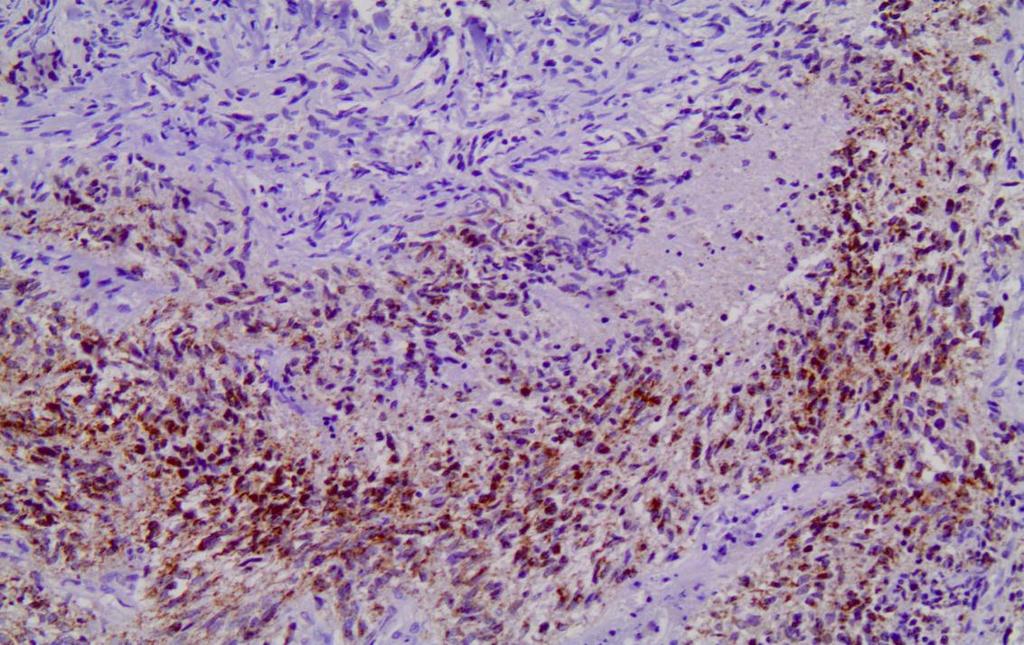 Εικόνα 13 Β: Θετικά για την ALDH5A1 γλοιακά κύτταρα σε