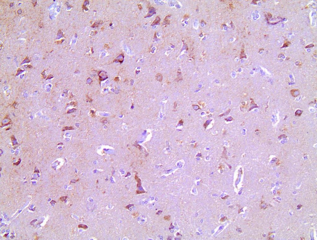 Εικόνα 13 Ε: Η θετική έκφραση της πρωτεΐνης ALDH5A1 αποδίδεται με καφέ χρώμα στα νεοπλασματικά κύτταρα της γλοίας τα οποία διατάσσονται περιαγγειακά.