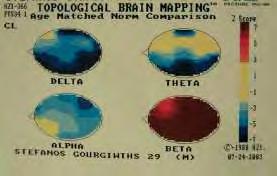 Παράδειγμα χαρτογραφικών ομοιοτήτων και διαφορών μεταξύ «σχιζοφρενών» ασθενών, σε σύγκριση με το δείγμα φυσιολογικού πληθυσμού του εγκεφαλογράφου: όλοι οι ασθενείς