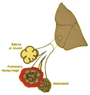 Leziuni pulmonare directe EPA necardiogen Contuzie pulmonară Aspiraţia conţinutului gastric Inhalare de toxine (fum, fosgen,