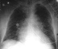 EPA cardiogen Radiografic Voalare difuză, bilaterală Cardiomegalie Liniile Kerley
