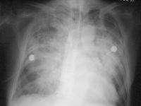 Radiografic Voalare difuză, bilaterală EPA necardiogen Cord de mărime normală Edem alveolar