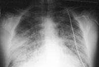 Radiografic Voalare difuză, bilaterală EPA necardiogen Cord de mărime normală Edem alveolar
