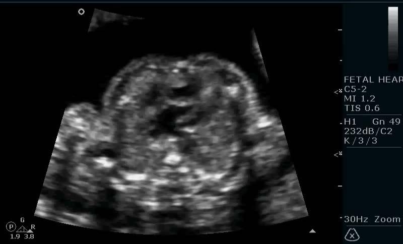 Υπερηχογράφημα καρδιάς εμβρύου - PDF Free Download