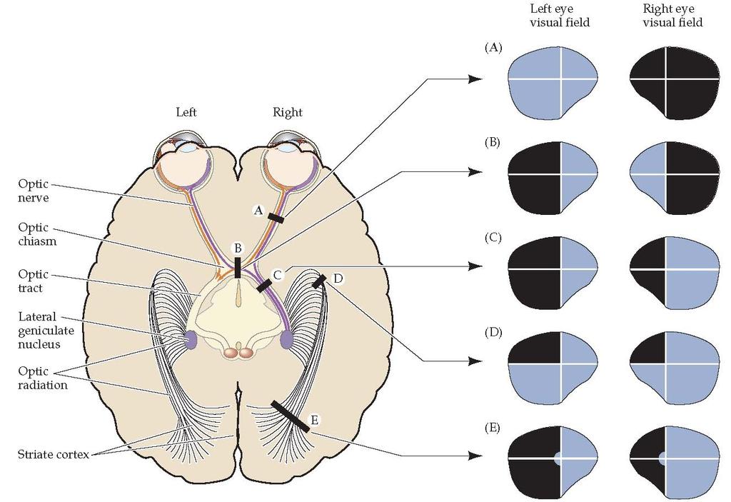 Visual deficits from damage at different points along the primary visual pathway