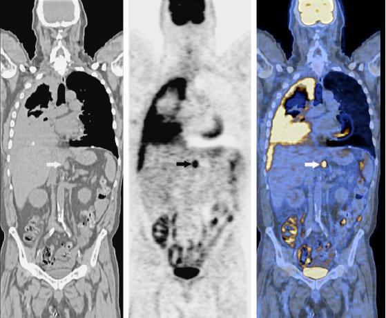 Άγνωστος ο ρόλος της PET/CT Ευαισθησία 81% - ειδικότητα 74%, για πρόβλεψη κακοήθειας σε