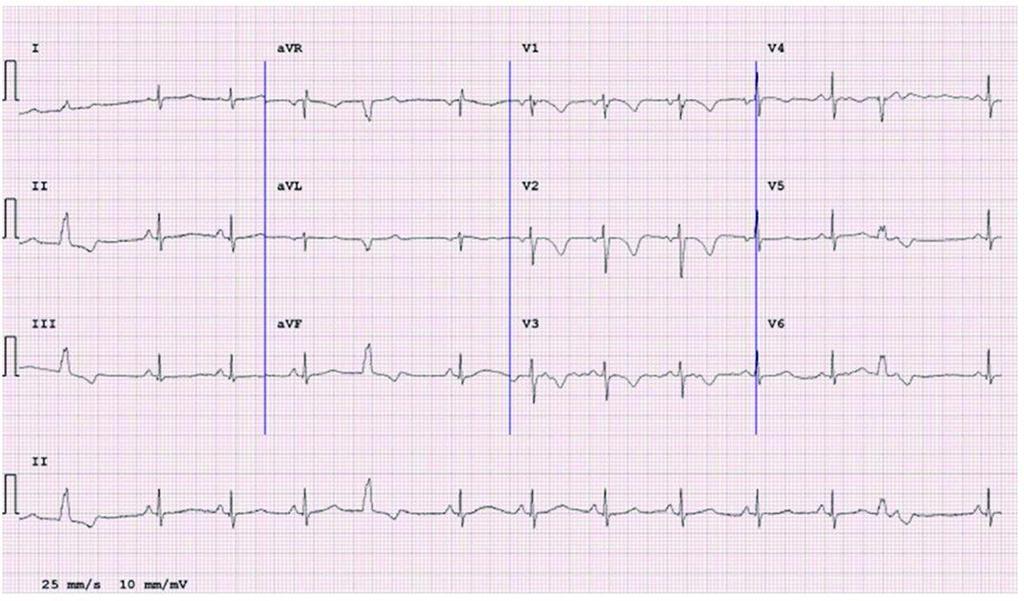 ECG from a 30-year-old patient with ARVC showing anterior TWI in V1-V3 preceded by a flat or