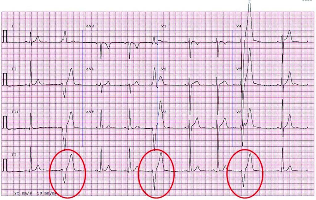 ECG from a patient with arrhythmogenic right ventricular