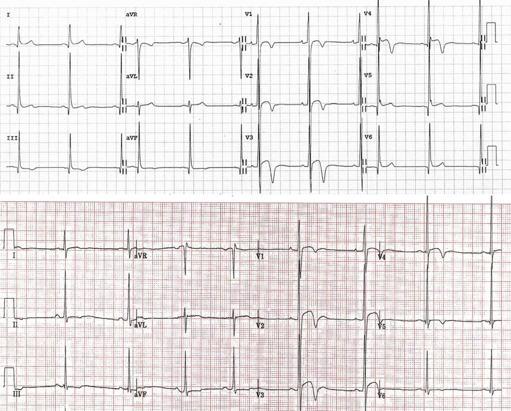 electrocardiographic anterior T-wave inversion in Athletes of different ethnicities: differential diagnosis between athlete's heart and cardiomyopathy From: Electrocardiographic anterior T-wave