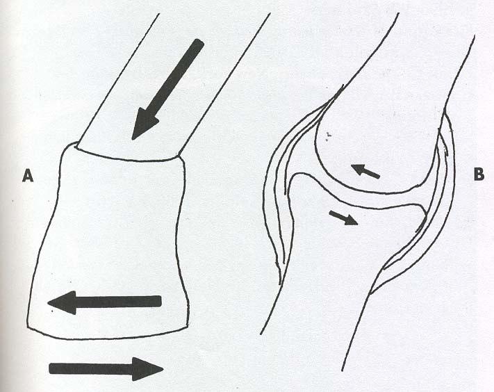 Ef bakkinn sígur, þá verður eccentrísk vöðvavinna á deltoid => þyngdarkrafturinn og það sem er á bakkanum, yfirvinnur krafta deltoid vöðvans.