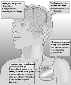Εικόνα 21: Διαδικασία τοποθέτησης ηλεκτροδίου στον εγκέφαλο Εικόνα 22: Σχηματική απεικόνιση ηλεκτροδίων διέγερσης στον εγκέφαλο και διεγέρτη Ο ακριβής τρόπος δράσης του ηλεκτρικού ερεθίσµατος που
