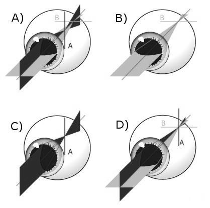 Astigmatismus teda delíme na: 1) astigmatismus jednoduchý (simplex), ktorého jeden meridián je emetropický a druhý buď myopický, alebo hypermetropický; 2) astigmatismus zloţený (compositus), ktorého