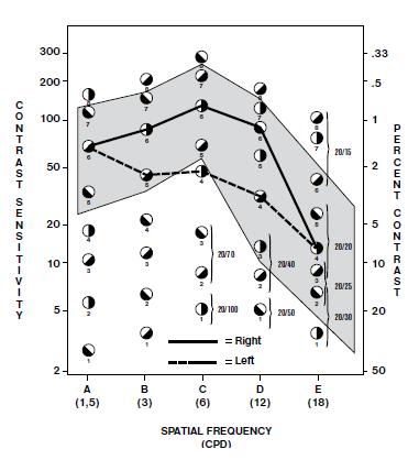 Obrázok 53. Krivka kontrastnej citlivosti (OD-normál, OS-glaukóm) Kontrastná citlivosť sa mení s vekom vo všetkých priestorových frekvenciách.