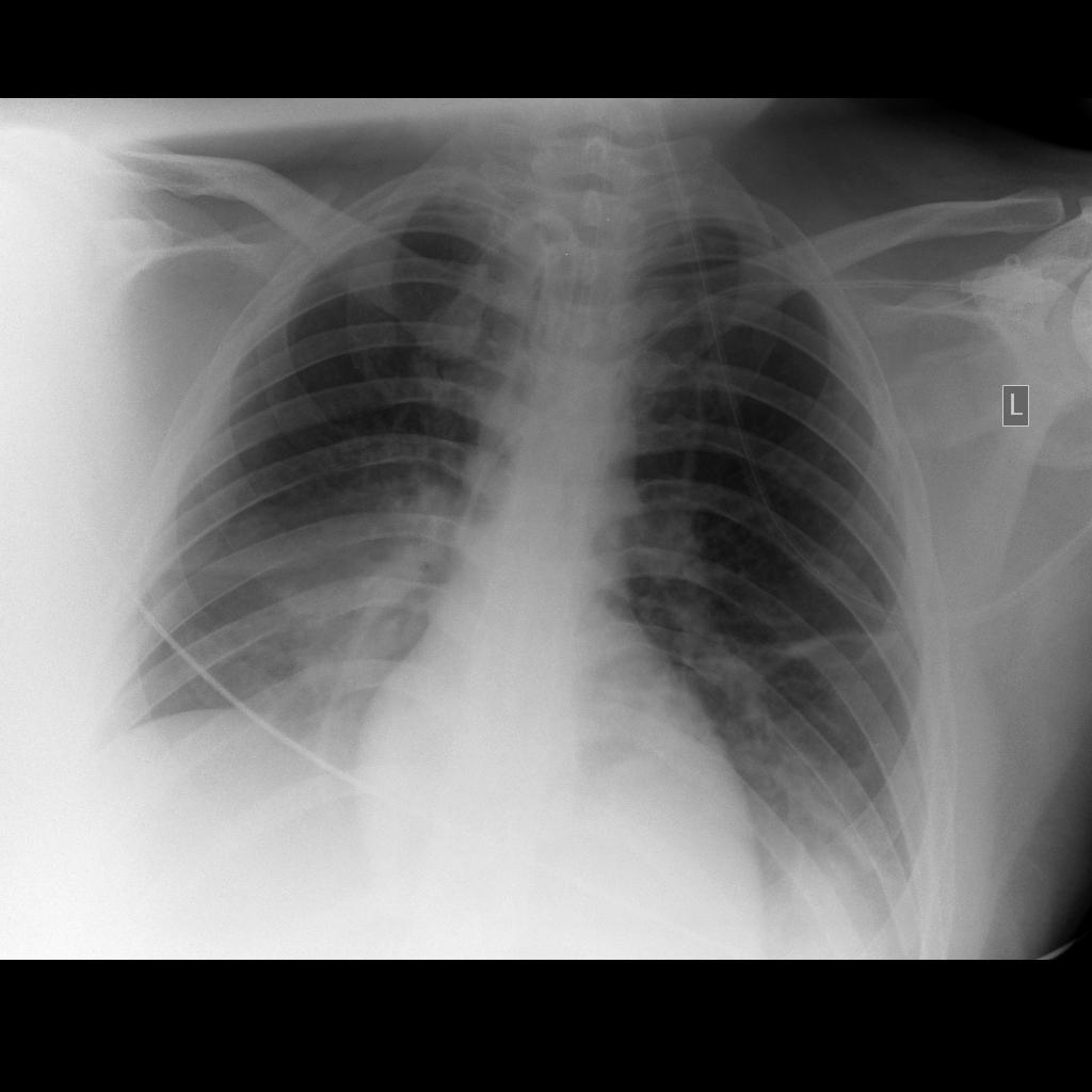 CXR ημερα