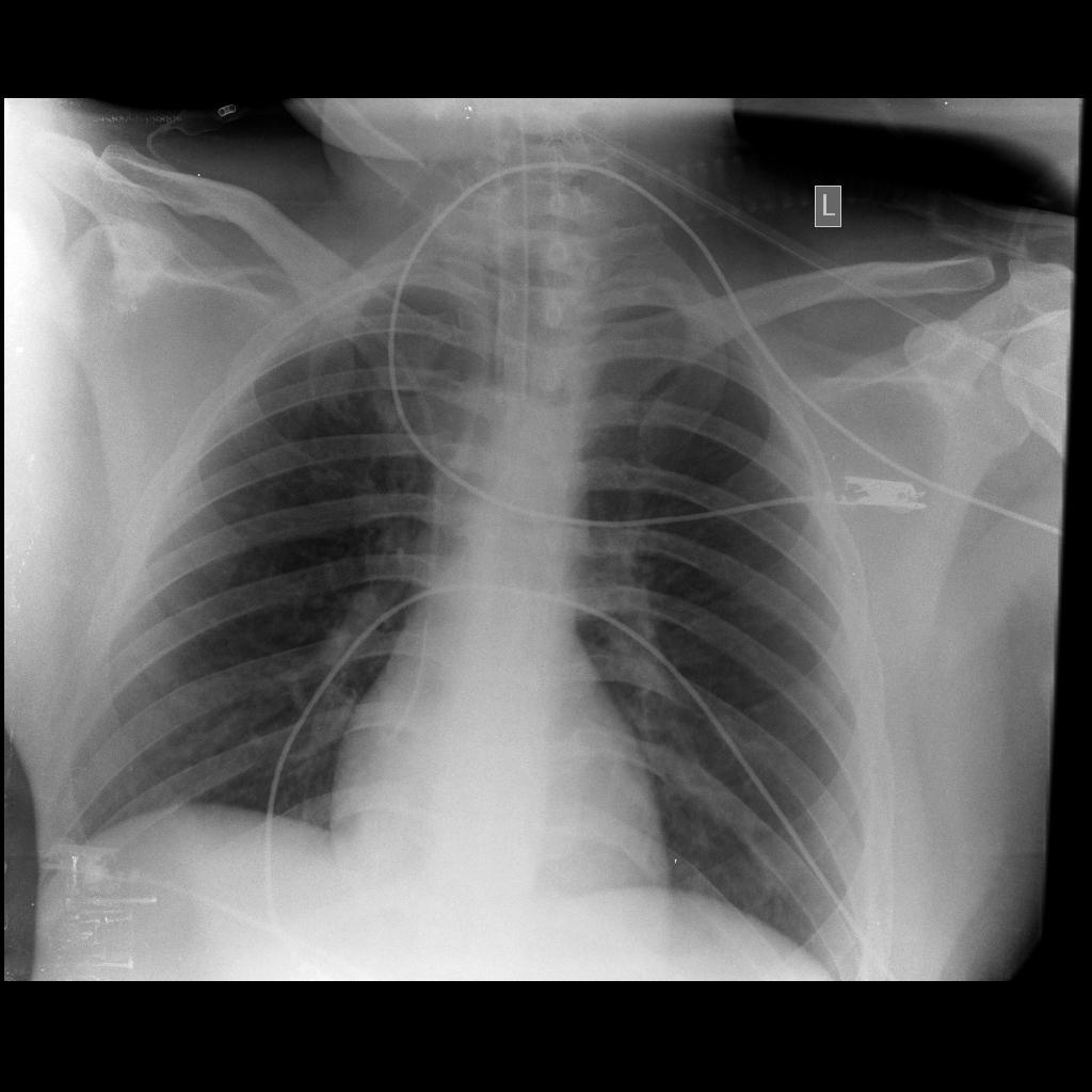 CXR