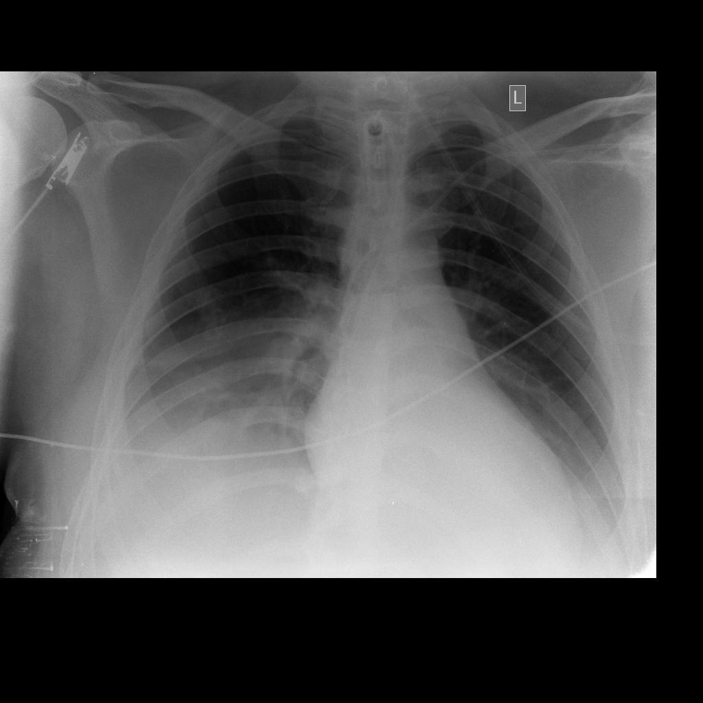 CXR ημερα