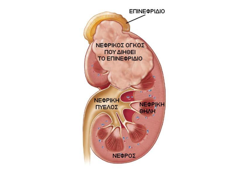 Ποία είναι η σταδιοποίηση του καρκίνου νεφρού; Ποία είναι η
