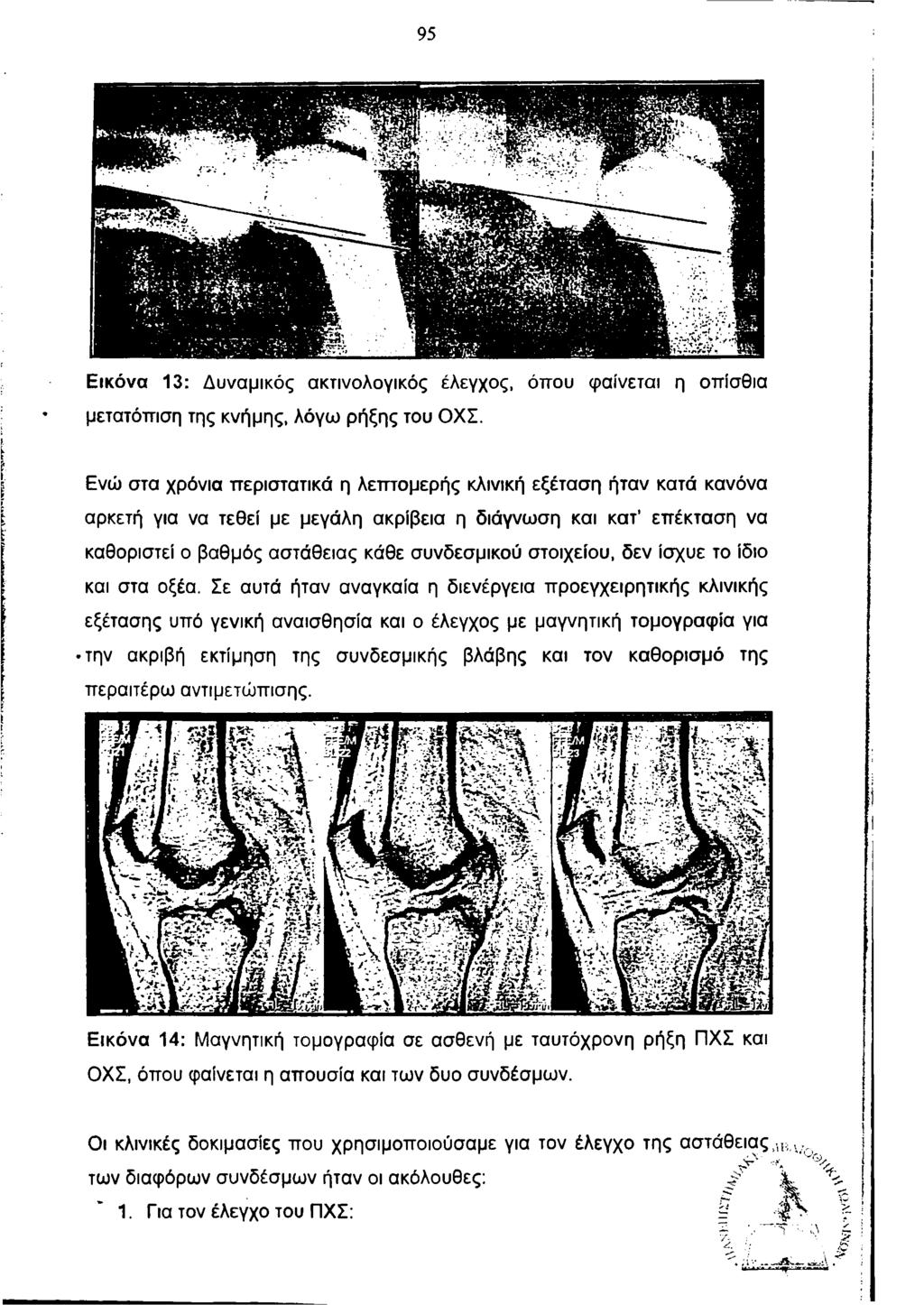 95 I! ι Εικόνα 13: Δυναμικός ακτινολογικός έλεγχος, όπου φαίνεται η οπίσθια μετατόπιση της κνήμης, λόγω ρήξης του ΟΧΣ.