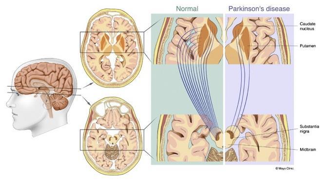 Νόσος Parkinson (IPD) 50 60% λιγότεροι μελαινο-ραβδωτοί νευρώνες 40 50% ελαττωμένη συγκέντρωση DaT
