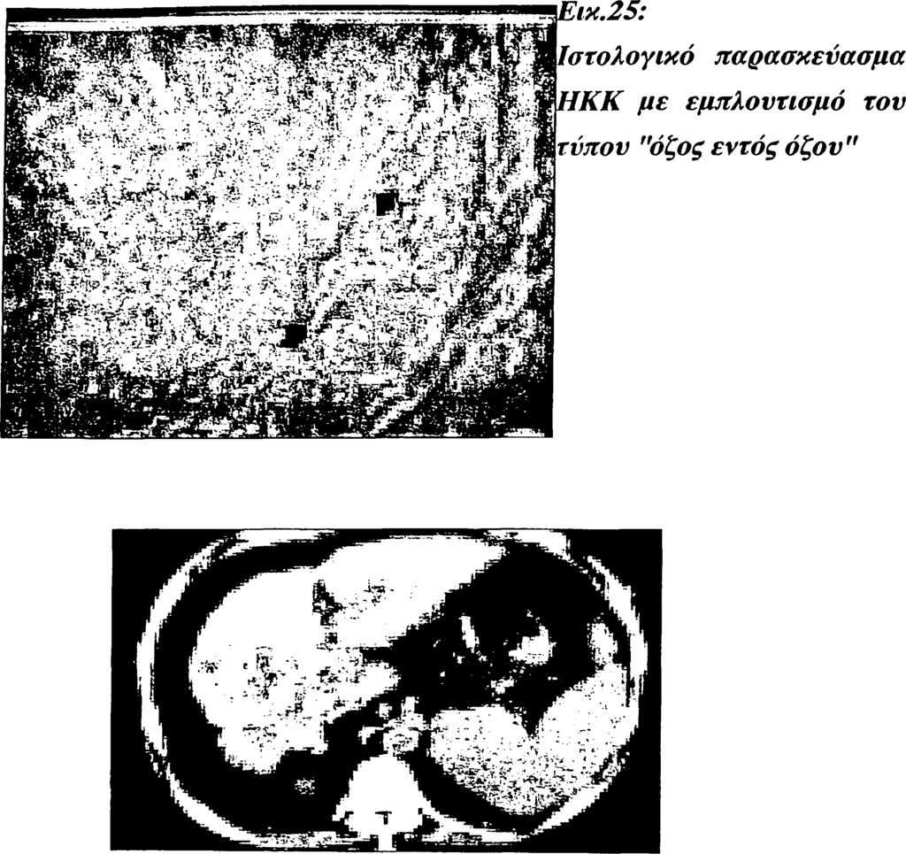 Εικ.26: Lipiodol CTσε πολλαπλούς όζους