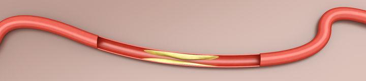Arterioskleroza: Skupljanje naslaga na unutarnjoj stijeni arterije može dovesti do njezina mjestimičnog sužavanja (arterioskleroza).