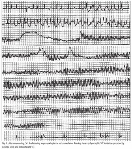 Εικόνα 8. Καταγραφή, σε Holter ρυθμού, κατεχολαμινεργικής πολύμορφης κοιλιακής ταχυκαρδίας κατά τη διάρκεια φυσικής δραστηριότητας, σε νεαρό ασθενή με ιστορικό συγκοπής στην άσκηση.