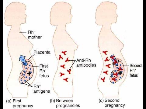 Αιμολυτικη αναιμία νεογνων 49 Μητερα Rh- και νεογνό Rh+ Κατά τον τοκετό Rh+ερυθροκύτταρα παιρνούν στην μητρική κυκλοφορία και