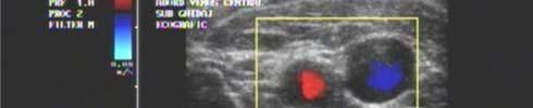 Identificarea prin Doppler color a
