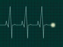 SR, 76bpm
