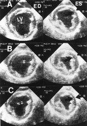 two-dimensional echocardiography in the ischemic region.