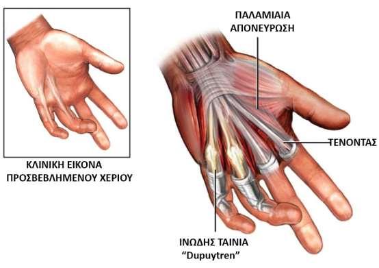 Μυς της άκρας χείρας Αρκετοί μυς που κινούν το χέρι βρίσκονται στο αντιβράχιο.